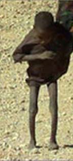 child_suffering_from_malnutrition_somali_children_.jpg