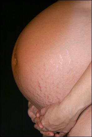stretchmarks2.jpg