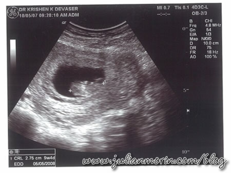 pregnancy_9weeks.jpg