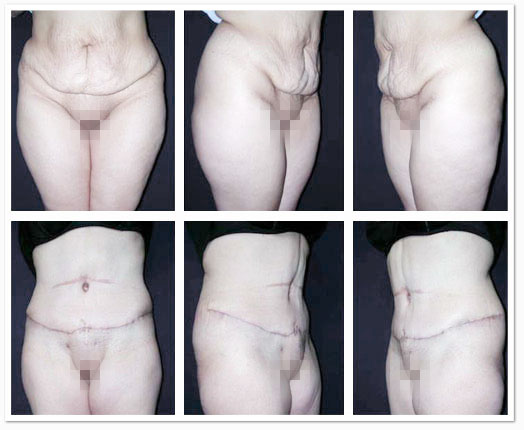 abdominoplastika_3.jpg