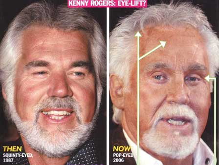 kenny_rogers_face_lift.jpg