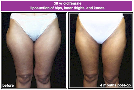 lipo_121199_patient_2.jpg