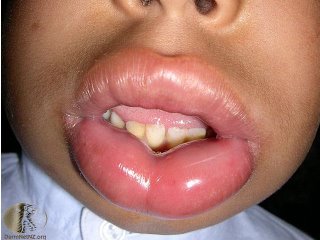 angioedema1.jpg