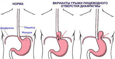 diafragmal_hernia.jpg