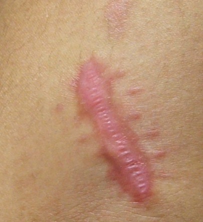keloid_removal_2.jpg